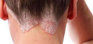 CBD oil treatment skin problems Psoriasis Seborea Dermatitis Eczema